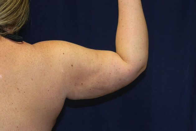 Arm Lift*/Arm Sculpting: Case 16 - After