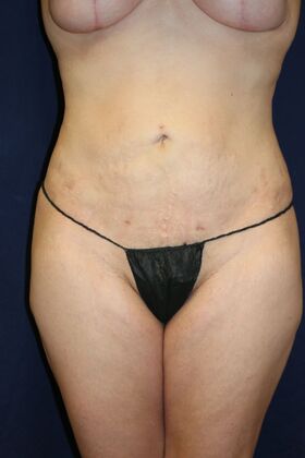 Brazilian Butt Lift : Case 17 - After