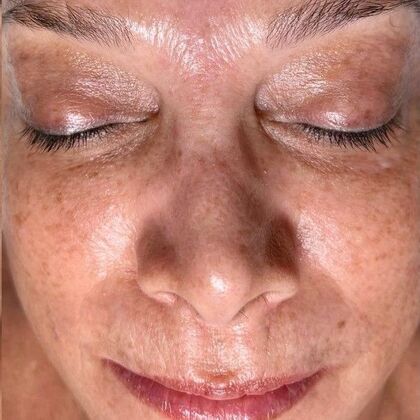 Hydrafacial: Case 4 - After