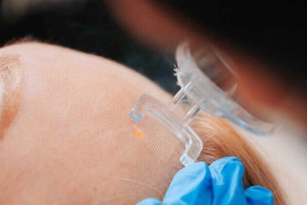 CO2 Laser Resurfacing
