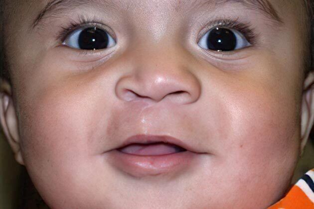 Cleft Lip*