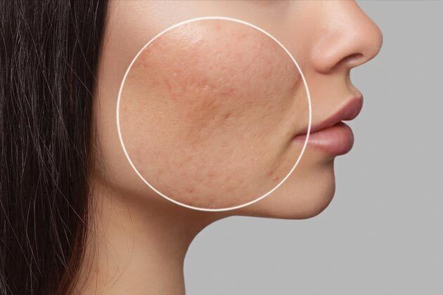 Laser Skin Resurfacing*
