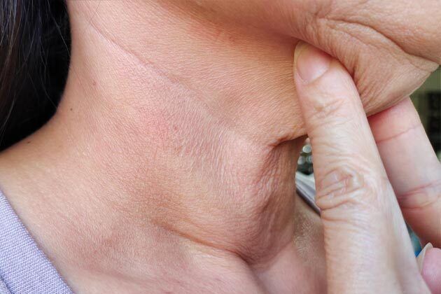 KYBELLA™ *