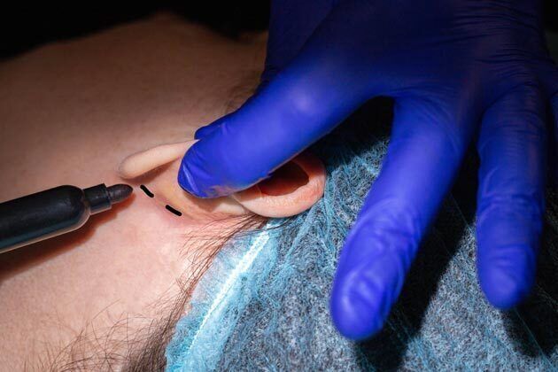 Otoplasty*