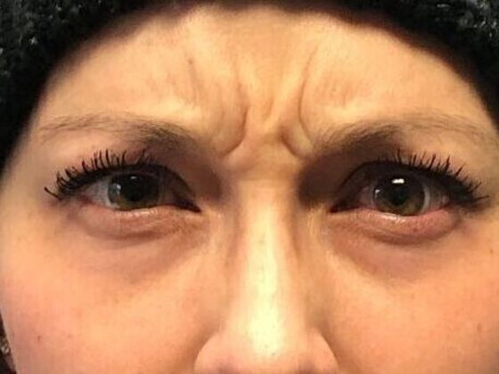 BOTOX® Cosmetic*: Case 7 - Before