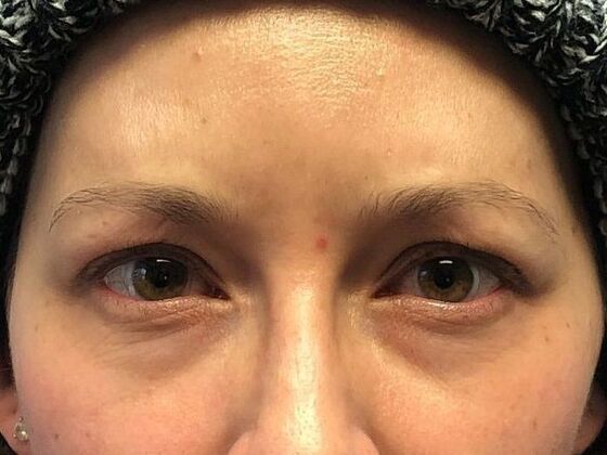 BOTOX® Cosmetic*: Case 7 - After