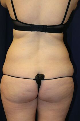 Liposuction & Safe Lipo: Case 53 - Before