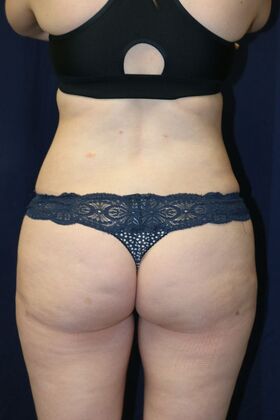 Liposuction & Safe Lipo: Case 53 - After