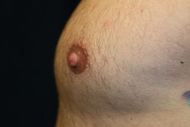 NIPPLE REDUCTION: Case 4 - After