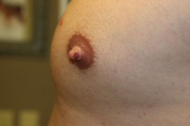 NIPPLE REDUCTION: Case 4 - Before