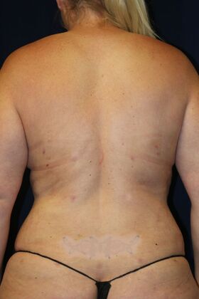 Liposuction & Safe Lipo: Case 54 - After