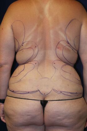 Liposuction & Safe Lipo: Case 54 - Before