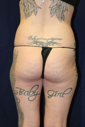 Brazilian Butt Lift : Case 9 - Before