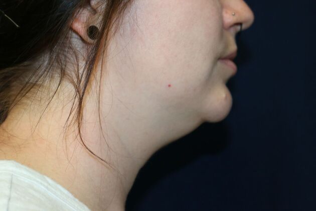 Neck Sculpting : Case 3 - Before