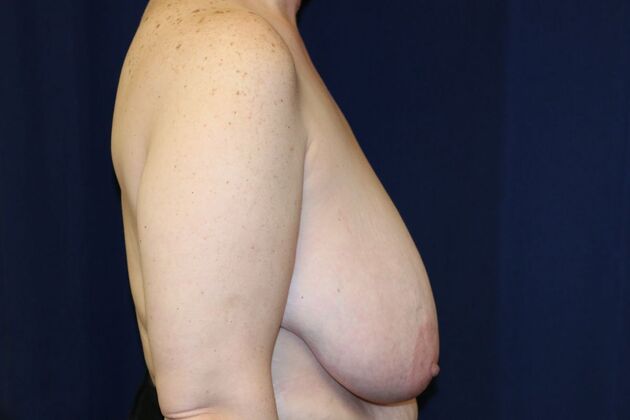 Breast Reduction*: Case 1 - Before