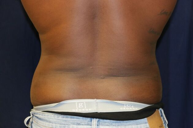 Abdominal Etching : Case 4 - After