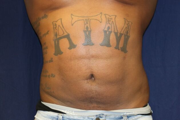 Abdominal Etching : Case 4 - After