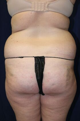LIPOSUCTION 360*: Case 1 - Before