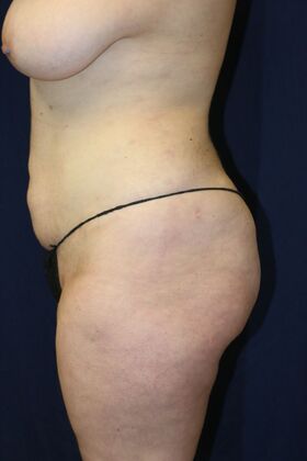 LIPOSUCTION 360*: Case 1 - After
