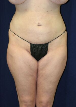 LIPOSUCTION 360*: Case 1 - After