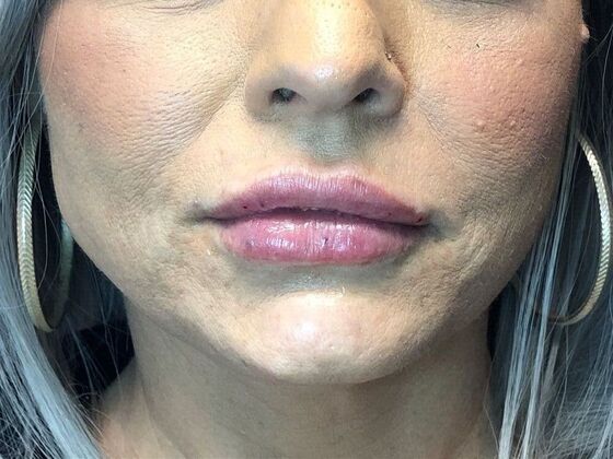 Cosmetic Injectables & Fillers*: Case 45 Lip Filler - After