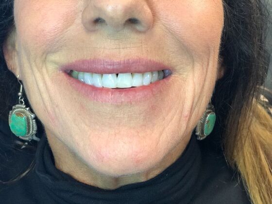 BOTOX® Cosmetic*: Case 8 - After