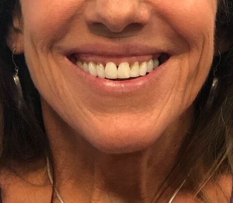 BOTOX® Cosmetic*: Case 8 - Before