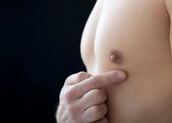 NIPPLE REDUCTION
