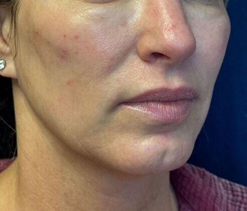 Cosmetic Injectables & Fillers*: Case 49- Cheek Filler - After