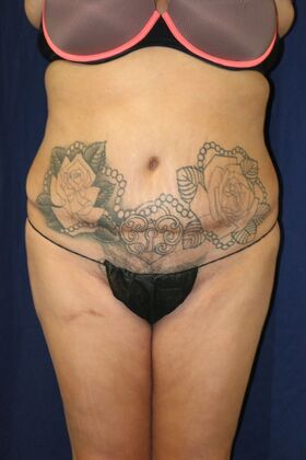 Brazilian Butt Lift : Case 7 - Before