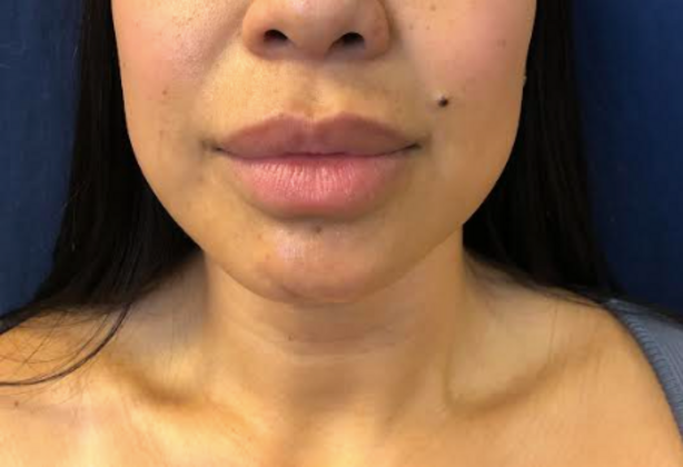 Cosmetic Injectables & Fillers*: Case 57 Lip Filler - Before