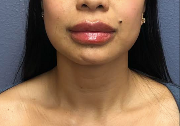Cosmetic Injectables & Fillers*: Case 57 Lip Filler - After