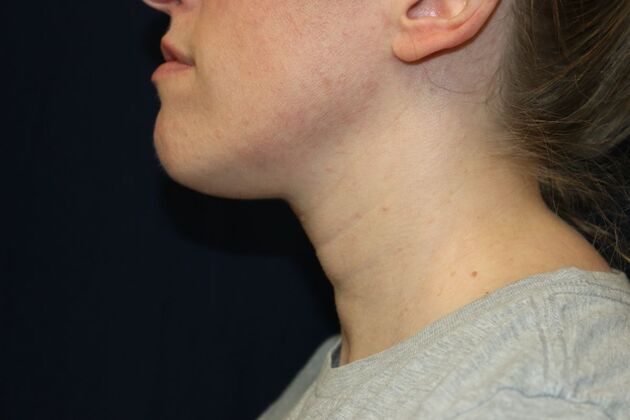 Neck Sculpting : Case 11 - After