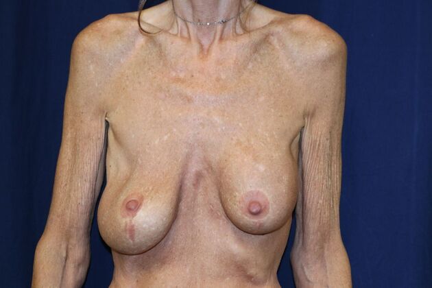 Breast Implant Removal and Exchange: Case 17 - Before