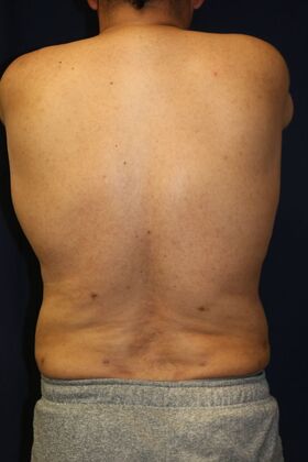 LIPOSUCTION 360*: Case 3 - After