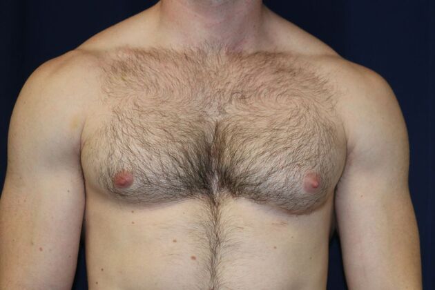Male Breast Reduction*: Case 10 - Before
