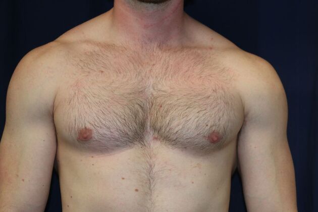 Male Breast Reduction*: Case 10 - After