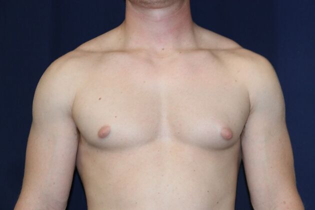 Male Breast Reduction*: Case 11 - Before