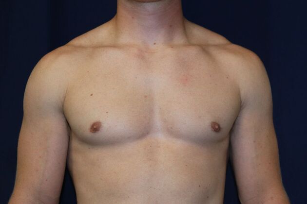Male Breast Reduction*: Case 11 - After