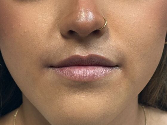 Cosmetic Injectables & Fillers*: Case 67 - Before