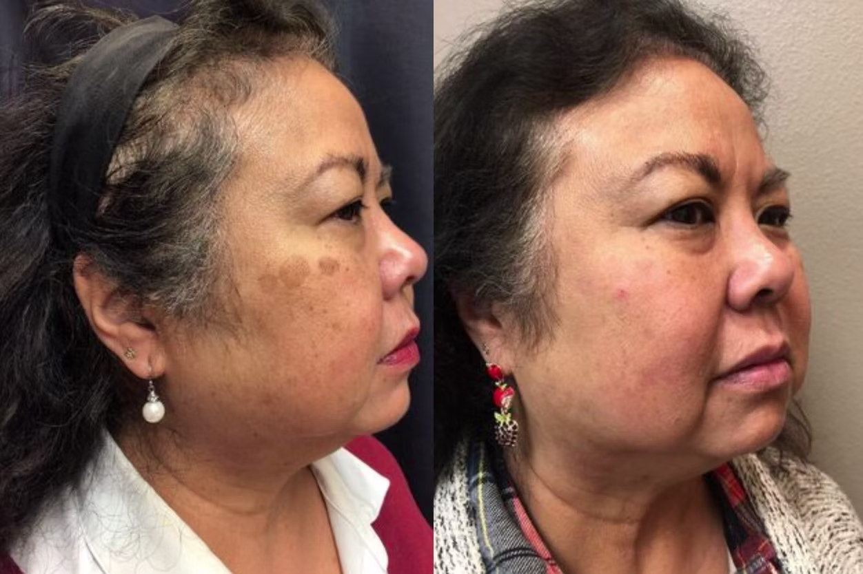 PicoSure Reno, NV – Lake Tahoe, NV – Murphy Plastic Surgery & Medical Spa