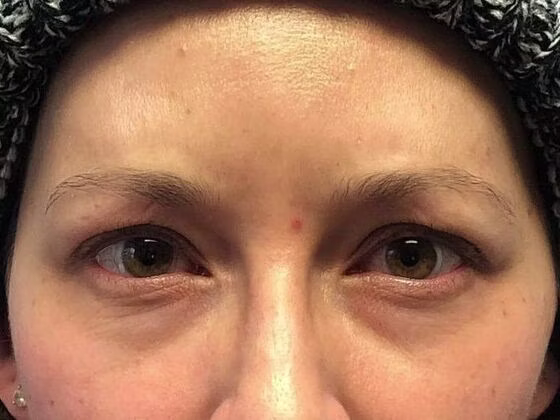 Botox in Reno, NV | Murphy Plastic Surgery & Medical Spa