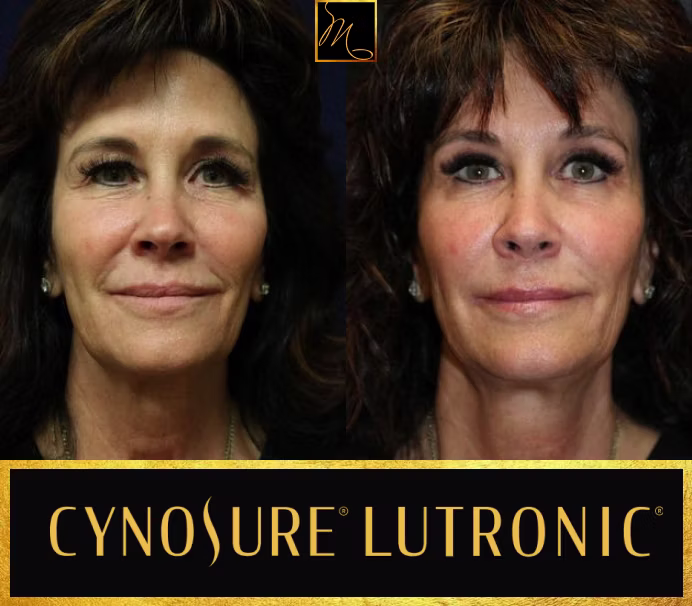 Microneedling in Reno, NV | Potenza RF & SkinPen