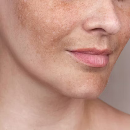 PicoSure Reno, NV – Lake Tahoe, NV – Murphy Plastic Surgery & Medical Spa