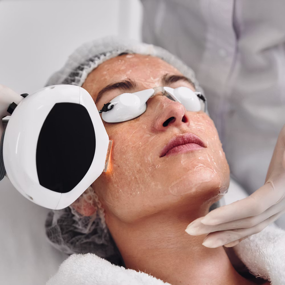 Microneedling in Reno, NV | Potenza RF & SkinPen